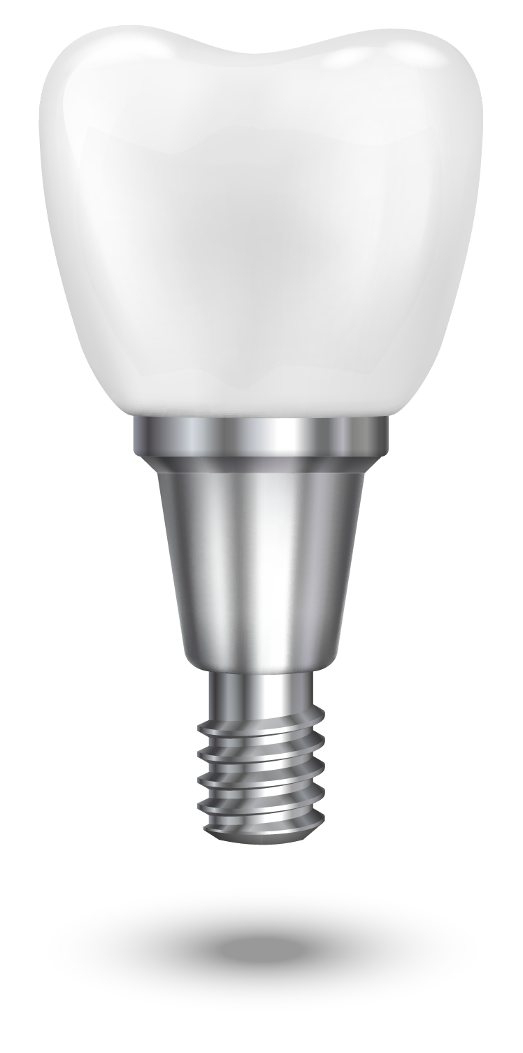 Implants-dentaires Implants-dentaires