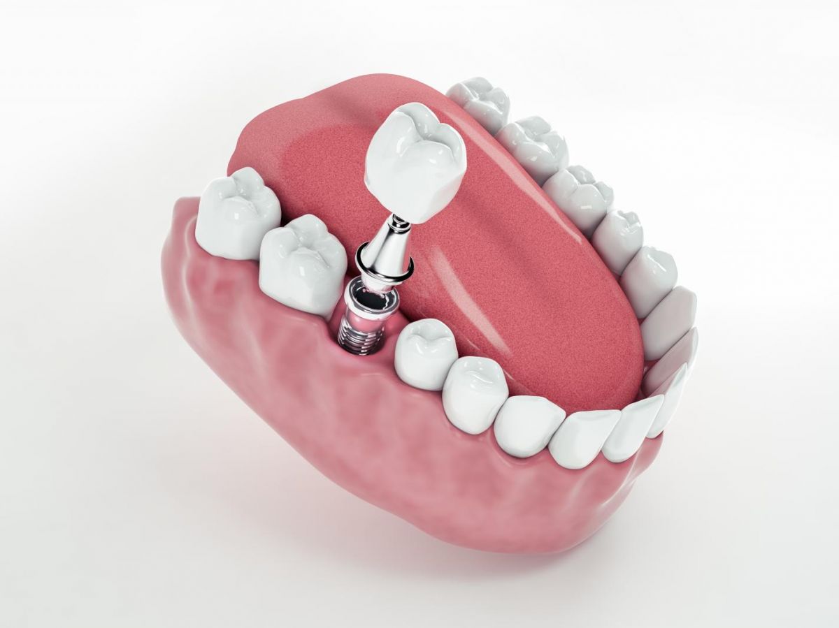 cover-r4x3w1200-655341d9c5e20-view-from-false-tooth-implant-fixed-jawbone-3d-3d-illustration cover-r4x3w1200-655341d9c5e20-view-from-false-tooth-implant-fixed-jawbone-3d-3d-illustration