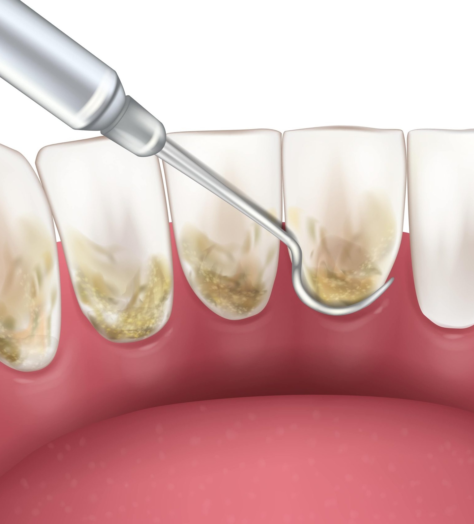 surfacage_radiculaire_que_faut-il_savoir_dentiste_laval-scaled surfacage_radiculaire_que_faut-il_savoir_dentiste_laval-scaled