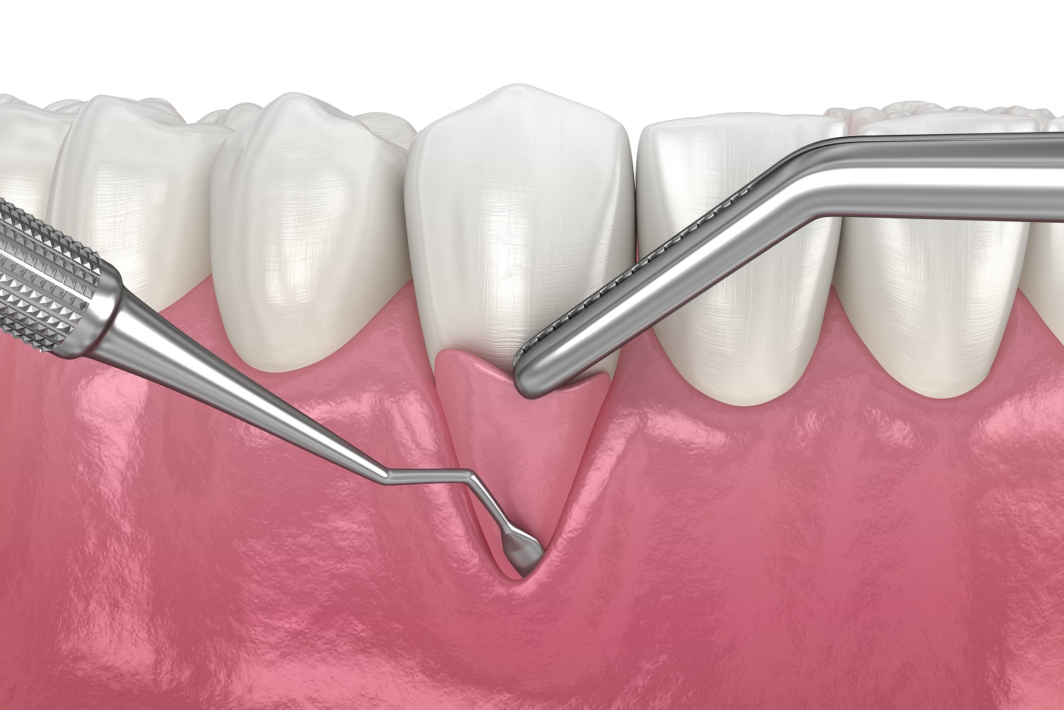 traitement-chirurgical-paro2 traitement-chirurgical-paro2