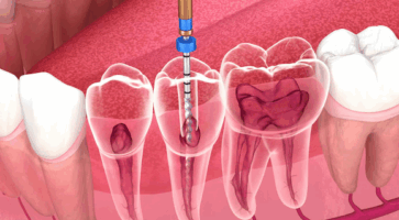 endodontie-dentaire